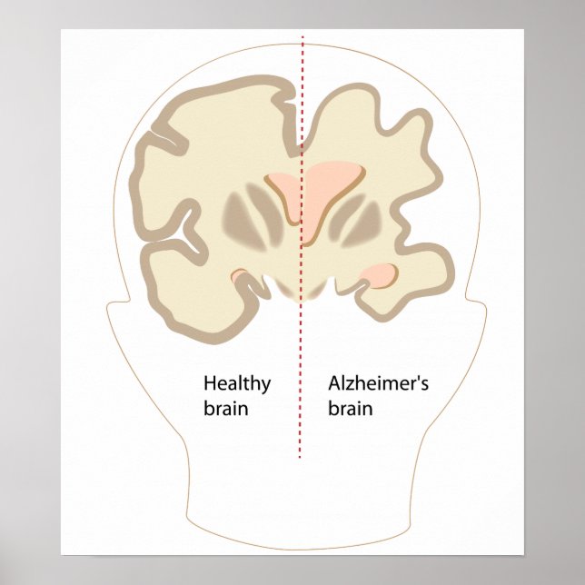 Alzheimer's disease brain Poster (Front)