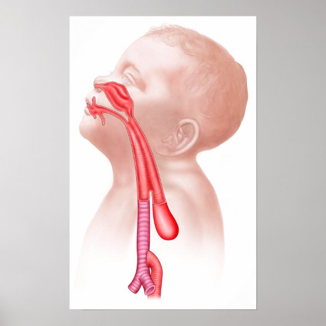 Anatomy Of A Tracheoesophageal Fistula Poster (Front)