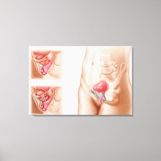 Anatomy Of Bladder Suspension Procedure Canvas Print (Front)