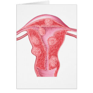 Anatomy Of Fibroid Tumours In Female Uterus