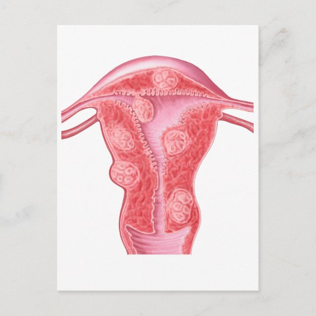 Anatomy Of Fibroid Tumours In Female Uterus Postcard (Front)