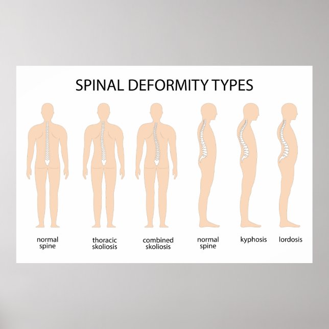 Anatomy of Spine deformity Poster (Front)