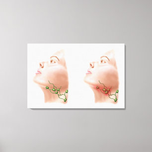 Anatomy Of Swollen Lymph Nodes Canvas Print