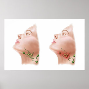 Anatomy Of Swollen Lymph Nodes Poster
