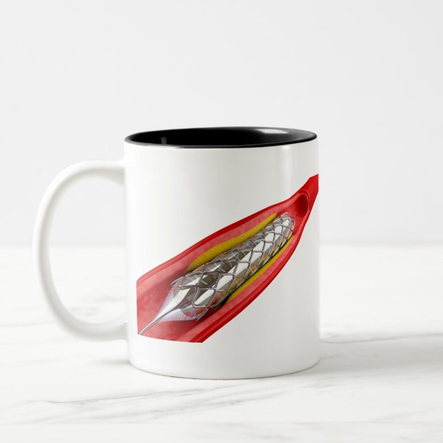 Angioplasty procedure Two-Tone coffee mug (Left)