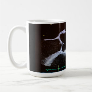 Aortic valve doppler echocardiogram cup
