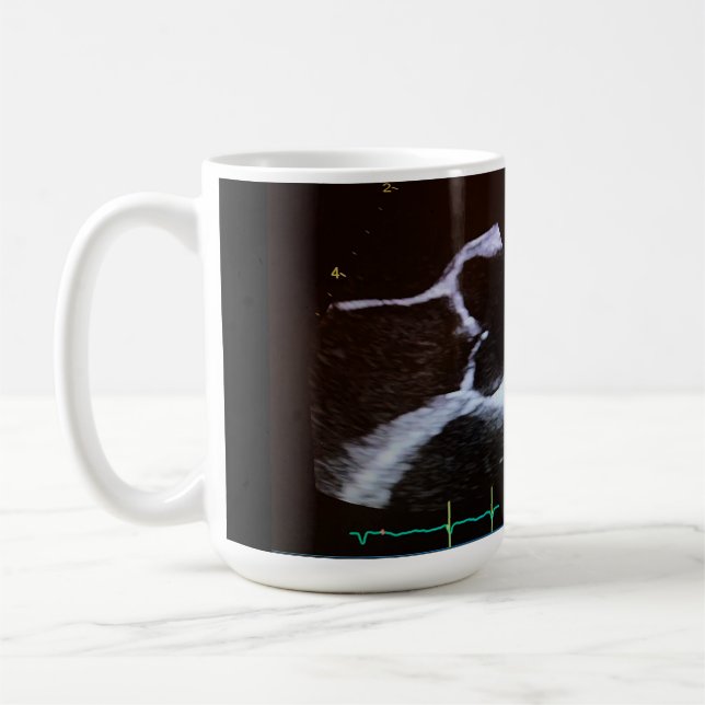Aortic valve doppler echocardiogram cup (Left)