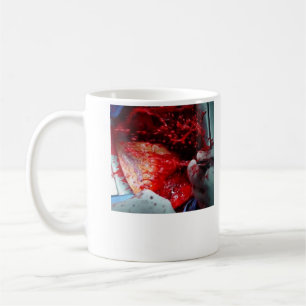 Ascending Aortic Dissection Coffee Mug