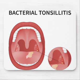 Bacterial tonsillitis mouse mat