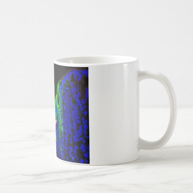 Barrett's oesophagus coffee mug (Right)
