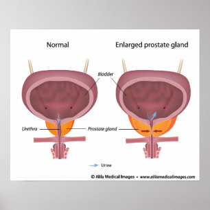 Benign prostatic hyperplasia, labelled diagram. poster