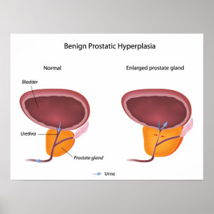Benign prostatic hyperplasia Poster