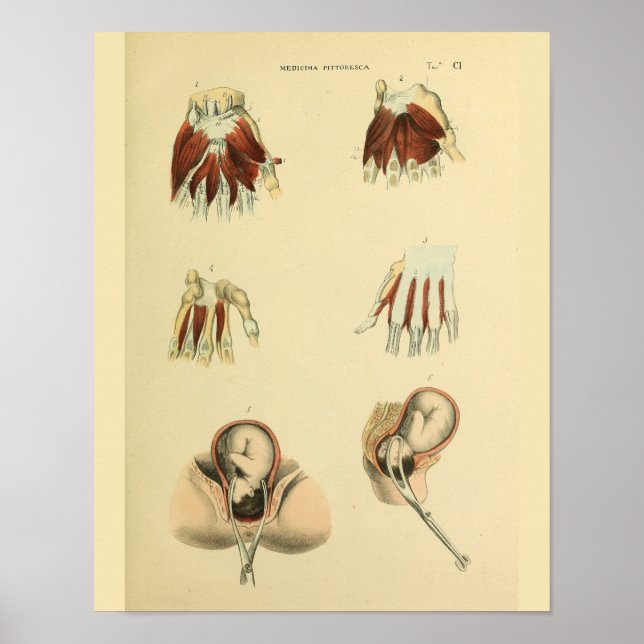 Birth Forceps Obstetrics Anatomy Medical Art Print (Front)