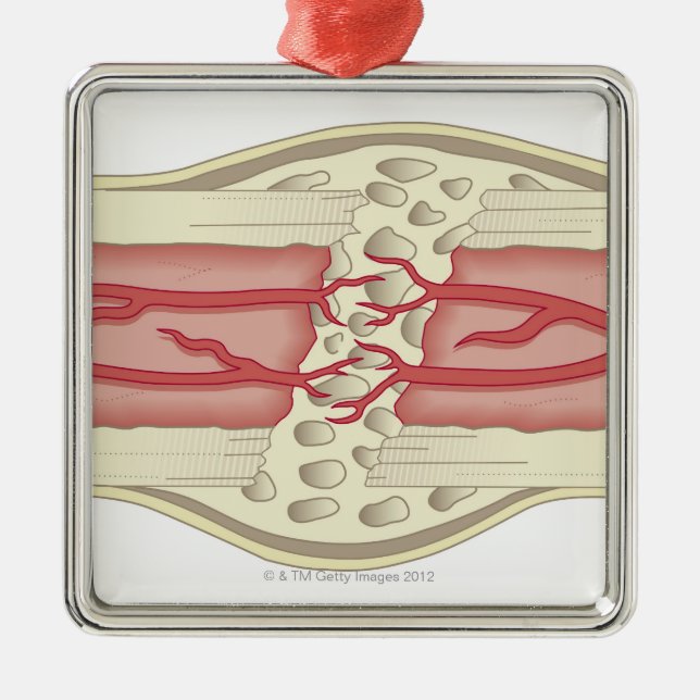 Bone Repairing Itself 2 Metal Tree Decoration (Front)