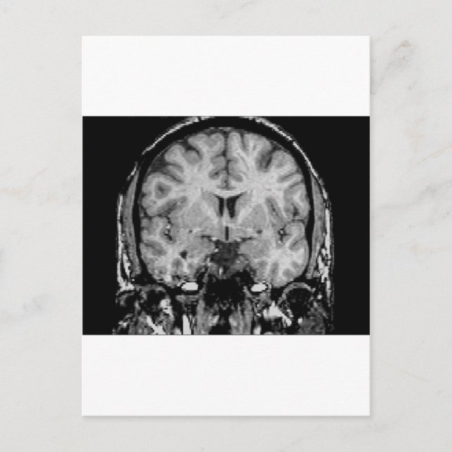 Brain MRI, coronal slice Postcard (Front)