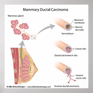 Breast cancer ductal carcinoma , labelled diagram. poster