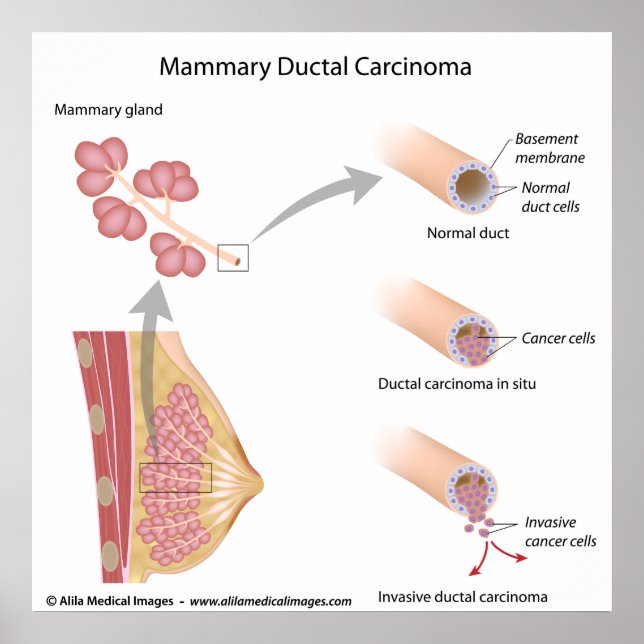 Breast cancer ductal carcinoma , labelled diagram. poster (Front)