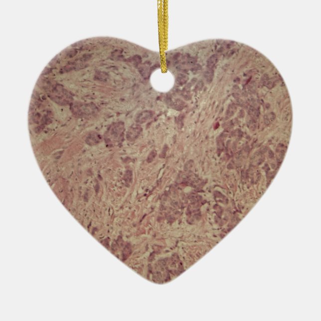 Breast cancer under the microscope ceramic tree decoration (Front)
