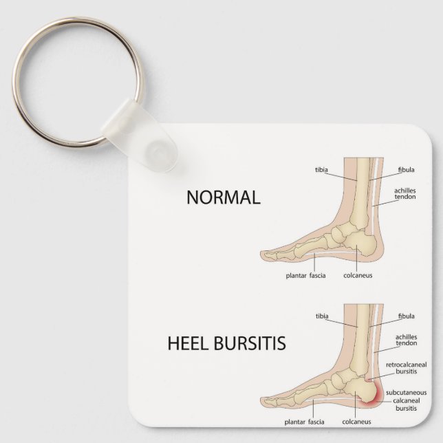 Calcaneal bursitis key ring (Front)