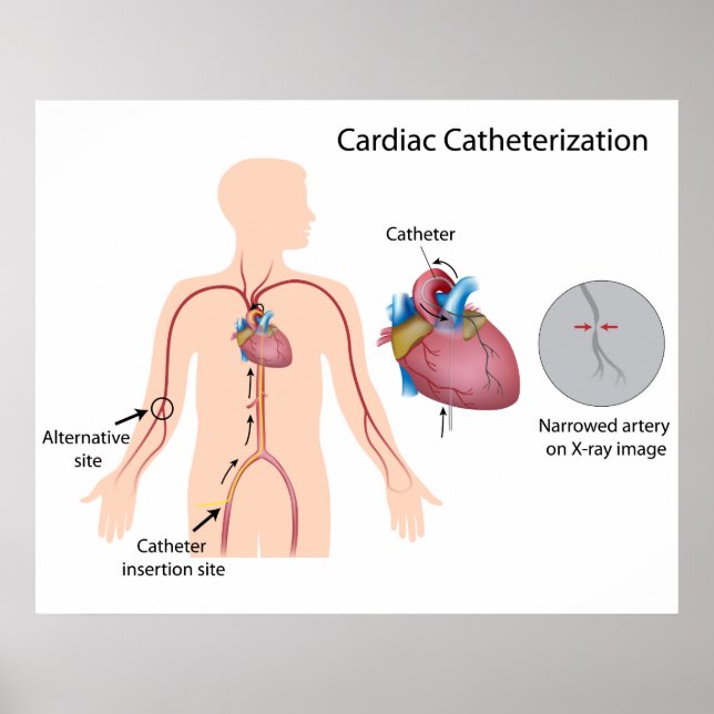 Cardiac catheterisation Poster (Front)
