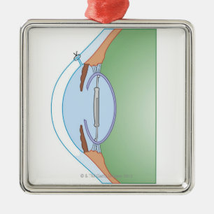 Cataract Surgery Metal Tree Decoration