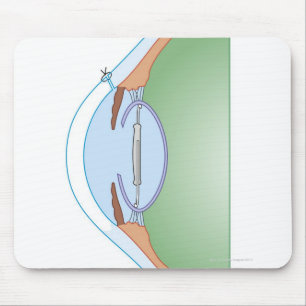Cataract Surgery Mouse Mat