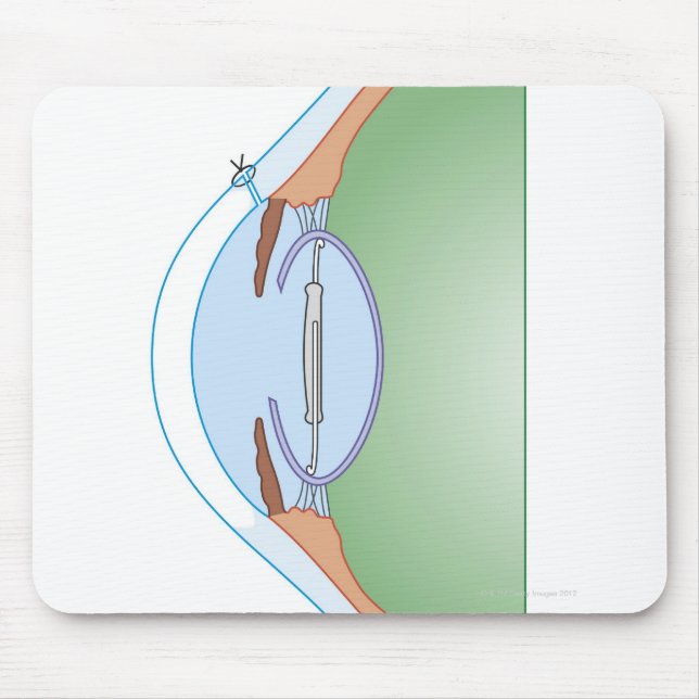 Cataract Surgery Mouse Mat (Front)