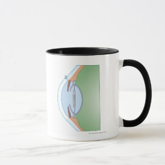 Cataract Surgery Mug