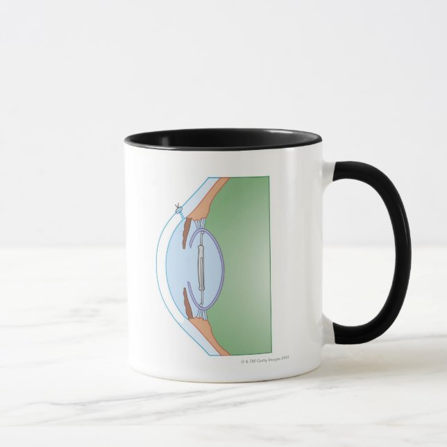 Cataract Surgery Mug (Right)