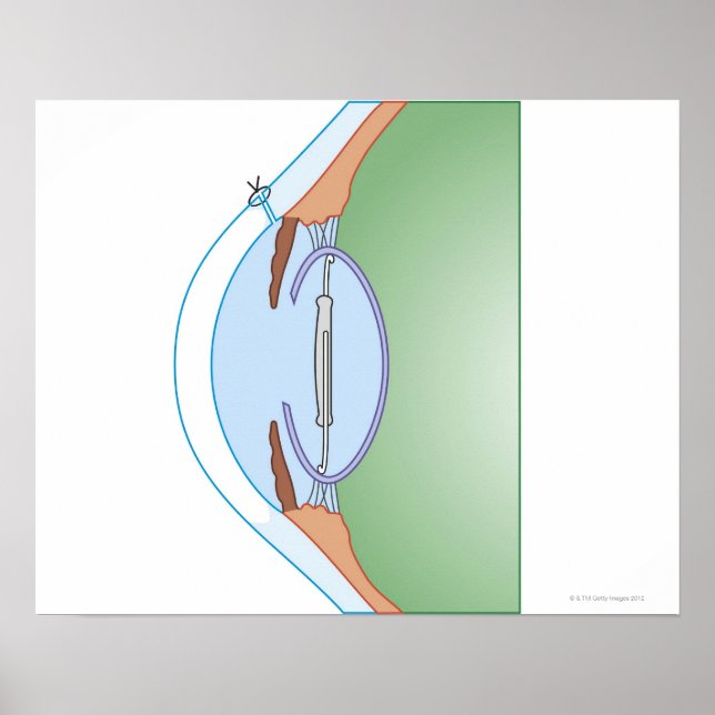 Cataract Surgery Poster (Front)
