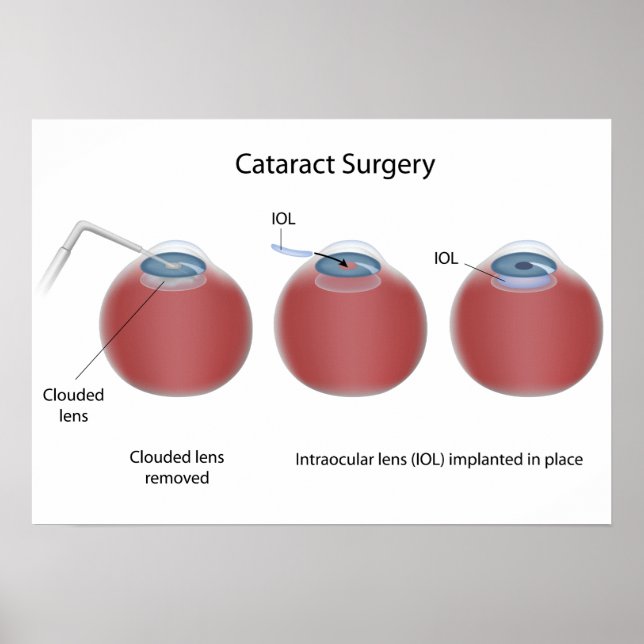 Cataract surgery  Poster (Front)