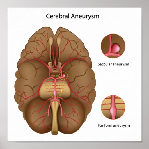 Cerebral aneurysm Poster | Zazzle.co.uk