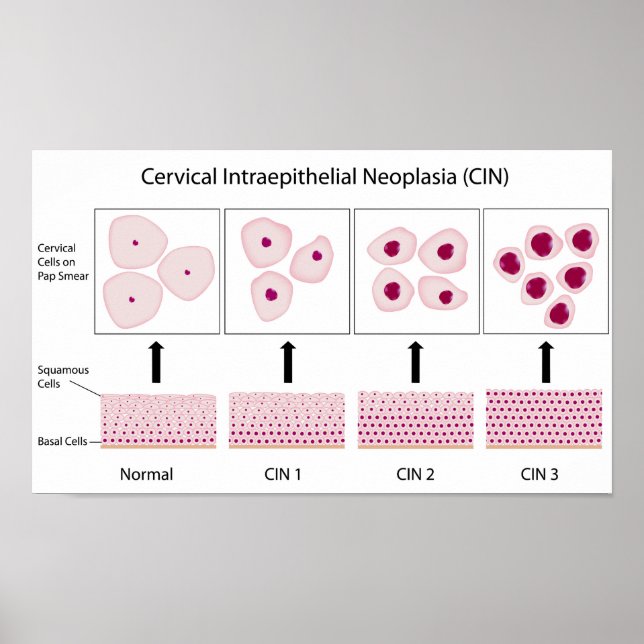 Cervical dysplasia stages and pap smear test poster (Front)