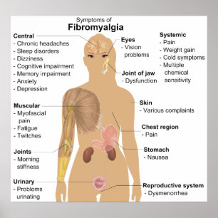 Chart of the Symptoms of Fibromyalgia
