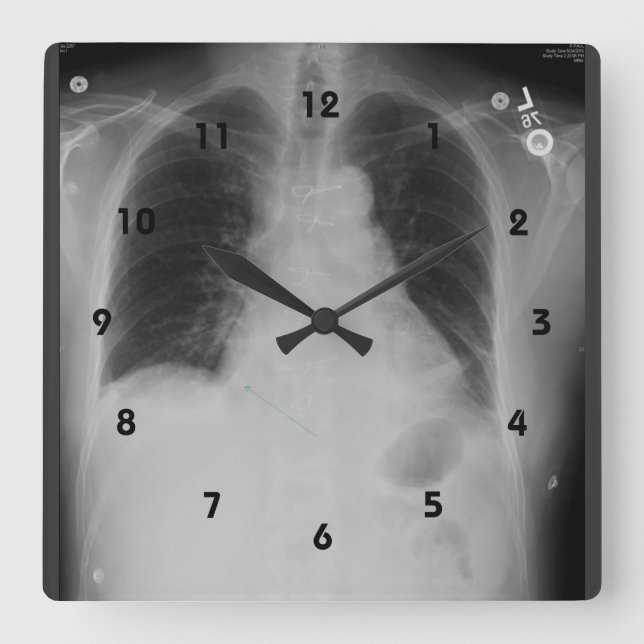 Chest X Ray ~ Clock (Front)