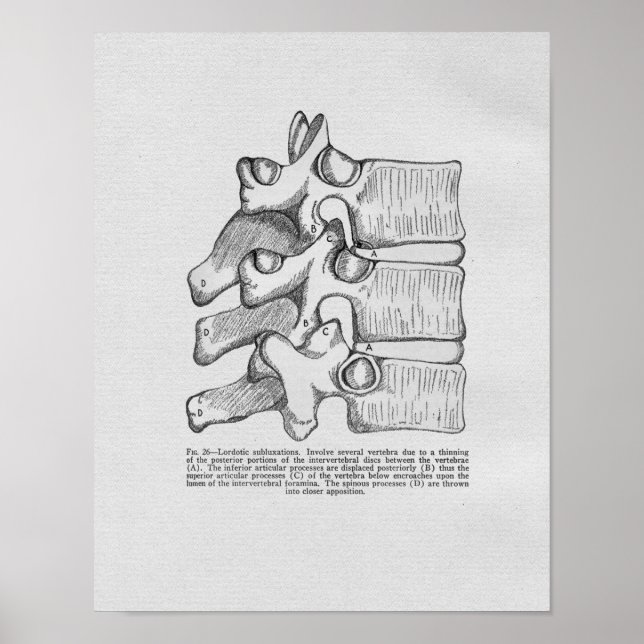 Chiropractic Subluxation Vintage Print (Front)