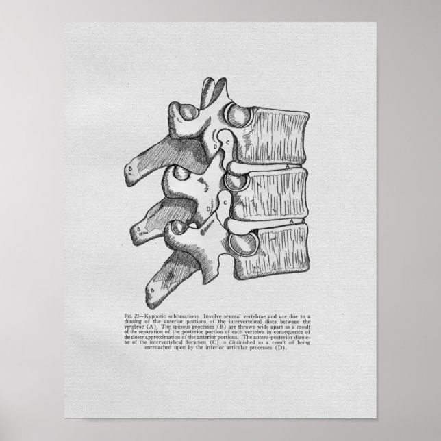 Chiropractic Subluxation Vintage Print (Front)