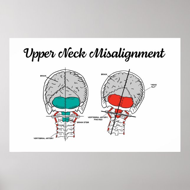 Chiropractic Upper Cervical Poster (Front)