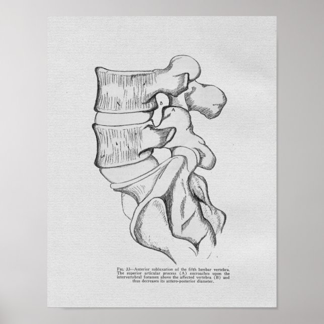 Chiropractic Vertebral Subluxation Vintage Print (Front)