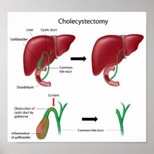 Cholecystectomy gallbladder removal surgery Poster