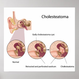 Cholesteatoma middle ear tumour Poster
