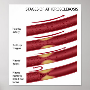 Cholesterol plaque stages Poster