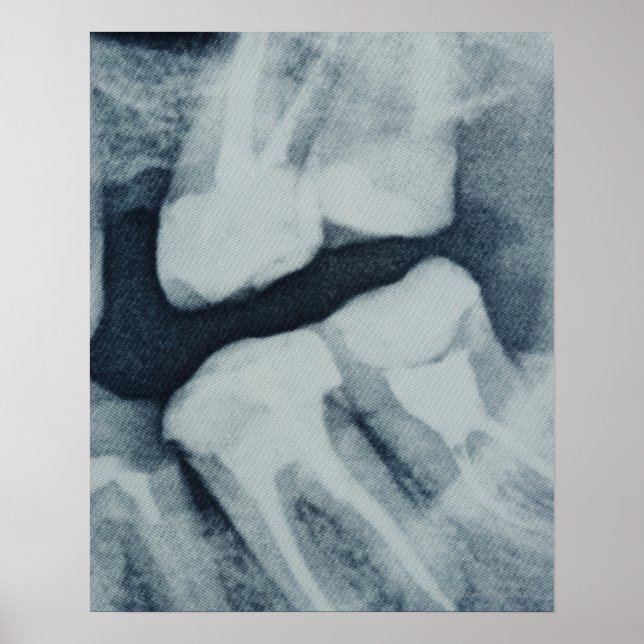 Close-up of a dental X-Ray Poster (Front)