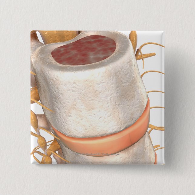 Close up of an invertebral disc in the spine 15 cm square badge (Front)