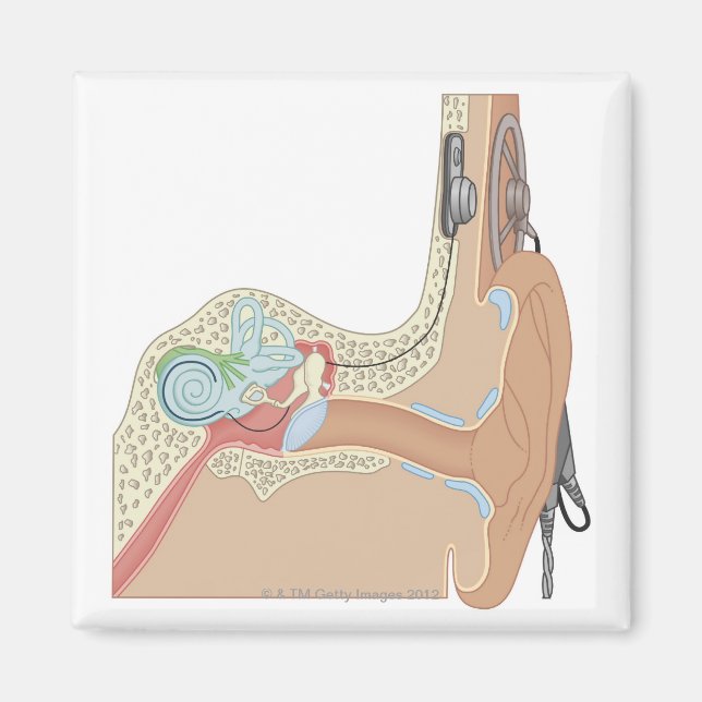 Cochlear Implants Magnet (Front)