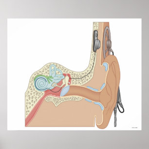 Cochlear Implants Poster