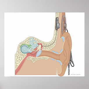 Cochlear Implants Poster