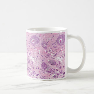 Coffee Mug-Breast Cancer Cells Mug