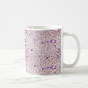 Coffee Mug - Chronic Myeloid Leukaemia (CML)