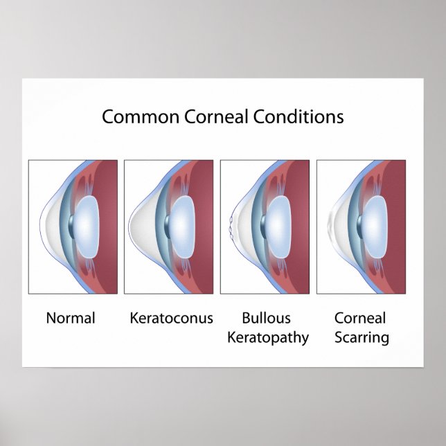 Common corneal conditions Poster (Front)